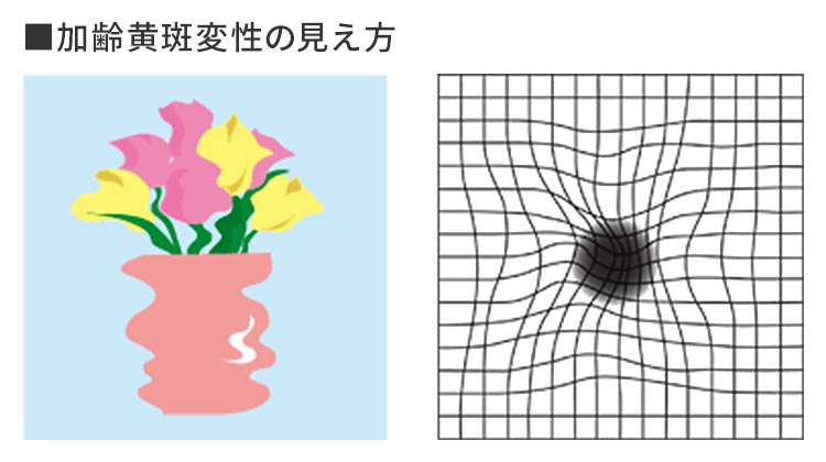 ドライ型AMDの管理